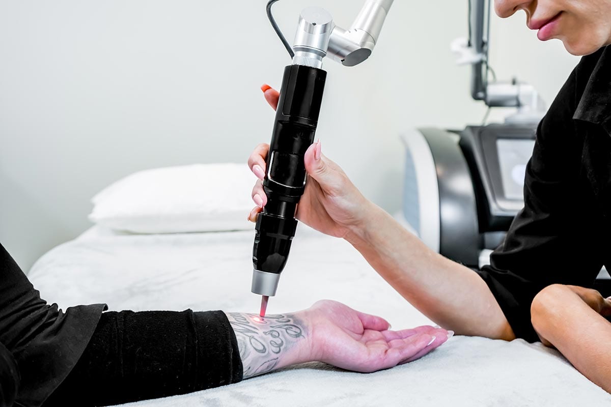 Tattoo Removal Laser Treatment.