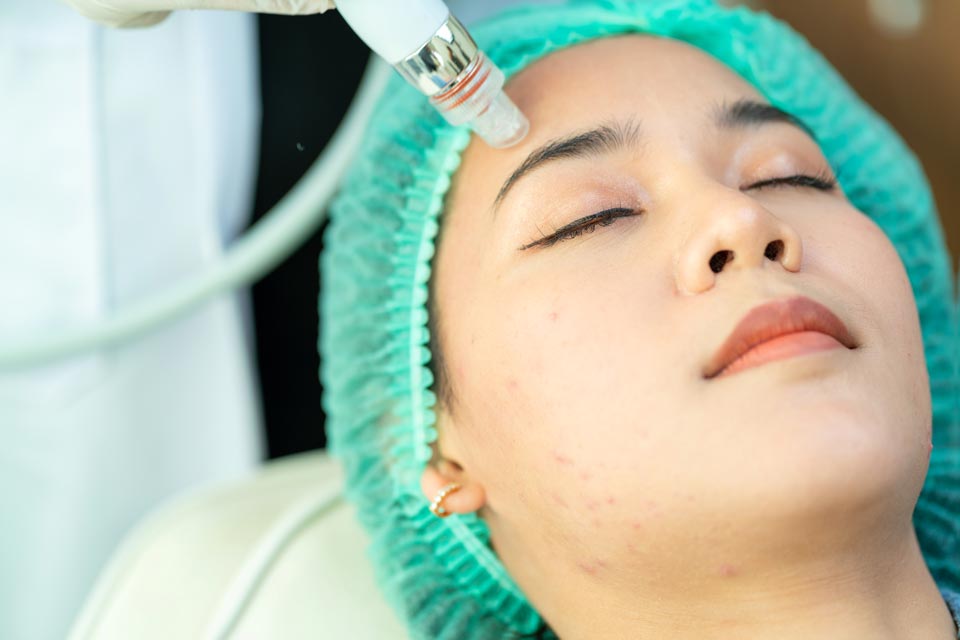 Laser Skin Treatment