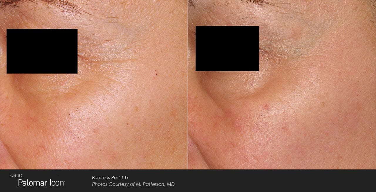 Skin-Renewal-Before-&-After-Photo-1