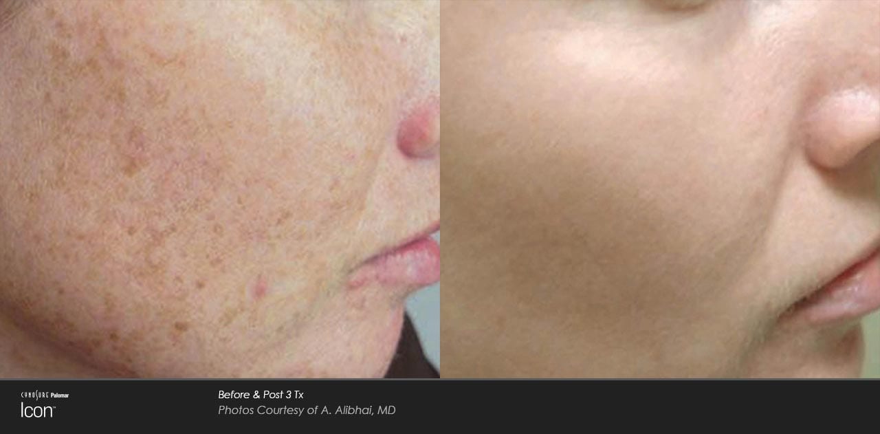 Skin-Revitalization-Before-&-After-Photo-1