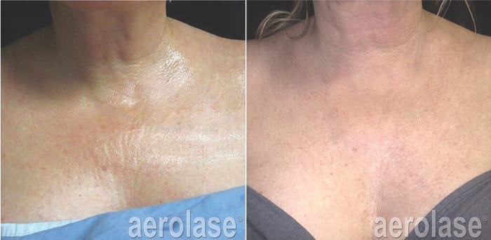 neoskin-rejuvenation-after-4-treatments-jason-emer-md